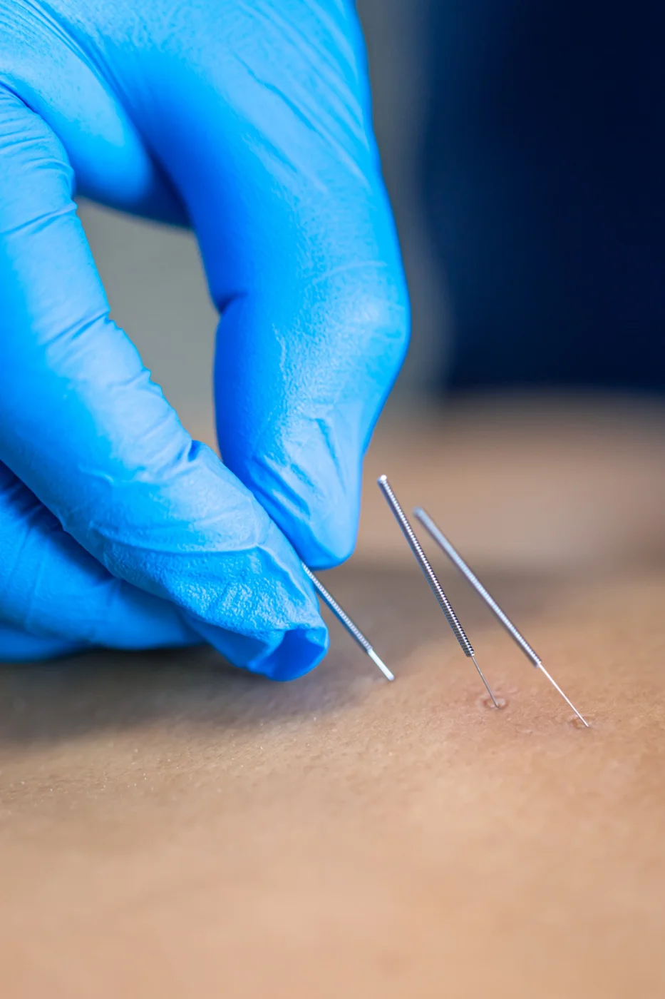 What is dry needling, and is it right for you?